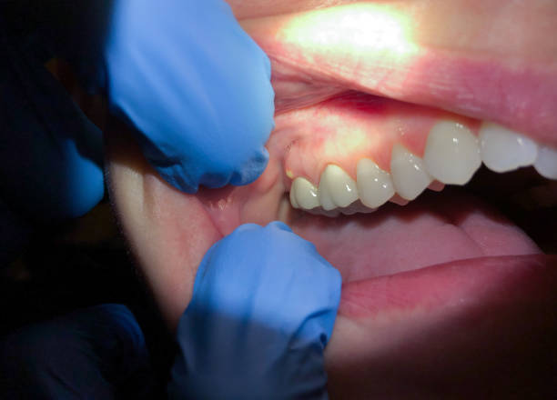 Best Emergency Denture Repair in Gold Key Lake, PA